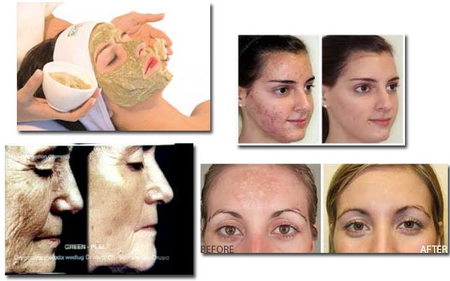 Φυτοπίλιγκ GREEN PEEL: Ένα πολύτιμο δώρο της Μητέρας Φύσης για το δέρμα μας