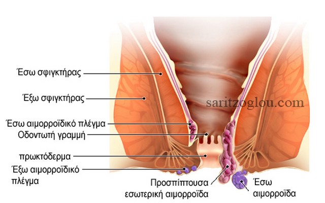 hemorrhoid  text 5   photo