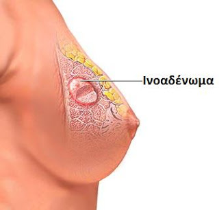 inoadenoma