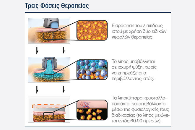 cryolipolisi 3faseis